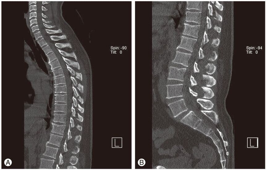 Деформация на междупрешленните дискове на MRI изображения при торакална остеохондроза