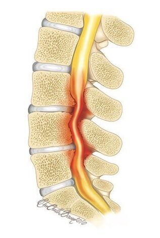 При остеохондроза на гръдния кош се получава компресия на гръбначния канал