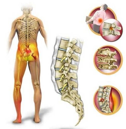 Остеохондроза на лумбалния гръбначен стълб, причиняваща болки в гърба